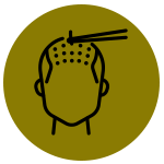 Hair Transplant