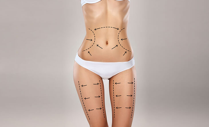 Liposuction Surgery- Get Rid Of Excess Fat & Shape Your Body Nicely &  Perfectly