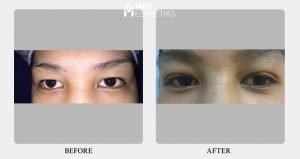 blepharoplasty - result - Dr Lokesh Handa -012