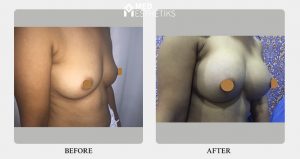 breast augmentation- Result- Dr Lokesh Handa -022