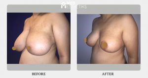 breast reduction - result - Dr Lokesh Handa -01