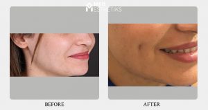dimple creation -result - Dr lokesh handa -012