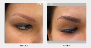 eyebrow hair transplant - result - Dr lokesh Handa -012