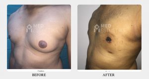 Asymmetric Gynecomastia Grade 2A-2B before after - Dr Lokesh Handa - Best plastic surgeon in delhi -03