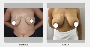 breast augmentation- Result- Dr Lokesh Handa -022