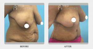 Breast Lift before after - Dr Lokesh Handa - Best plastic surgeon in delhi -01
