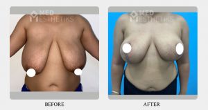 Breast Lift before after - Dr Lokesh Handa - Best plastic surgeon in delhi -01