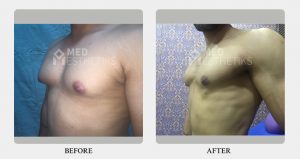 Gynecomastia Grade 1-2A before after - Dr Lokesh Handa - Best plastic surgeon in delhi -03