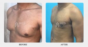 Gynecomastia Surgery before after - Dr Lokesh Handa - Best plastic surgeon in delhi -03
