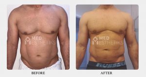 Liposuction Surgery before after - Dr Lokesh Handa - Best plastic surgeon in delhi -04