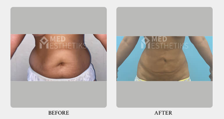 Liposuction Surgery before after - Dr Lokesh Handa - Best plastic surgeon in delhi -04