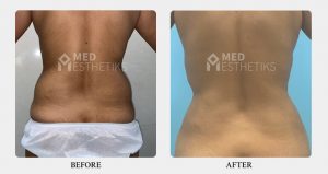 Liposuction Surgery before after - Dr Lokesh Handa - Best plastic surgeon in delhi -04