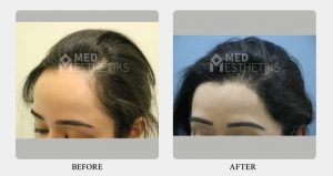 hairline before after - Dr Lokesh Handa - Best plastic surgeon in delhi -05