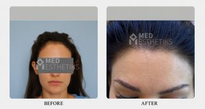 hairline before after - Dr Lokesh Handa - Best plastic surgeon in delhi -05