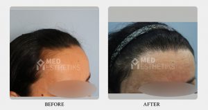 hairline before after - Dr Lokesh Handa - Best plastic surgeon in delhi -05