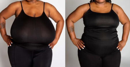 Does a Breast Reduction Make You Look Thinner?