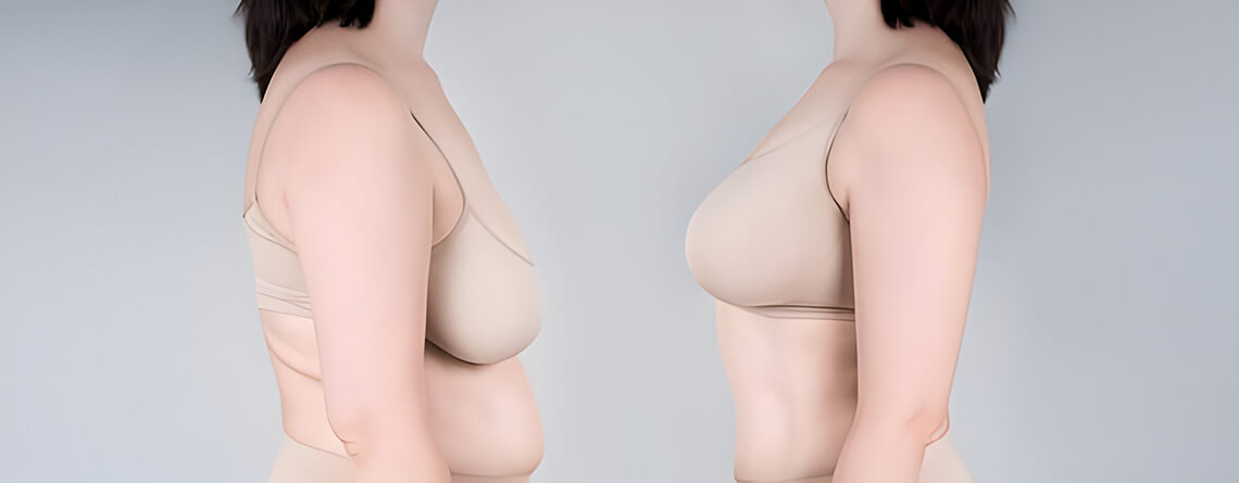 Breast Augmentation Surgery