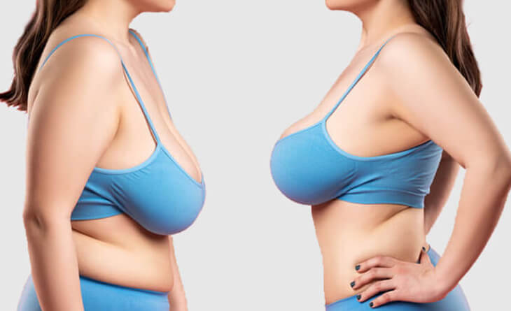 Breast Reduction Surgery