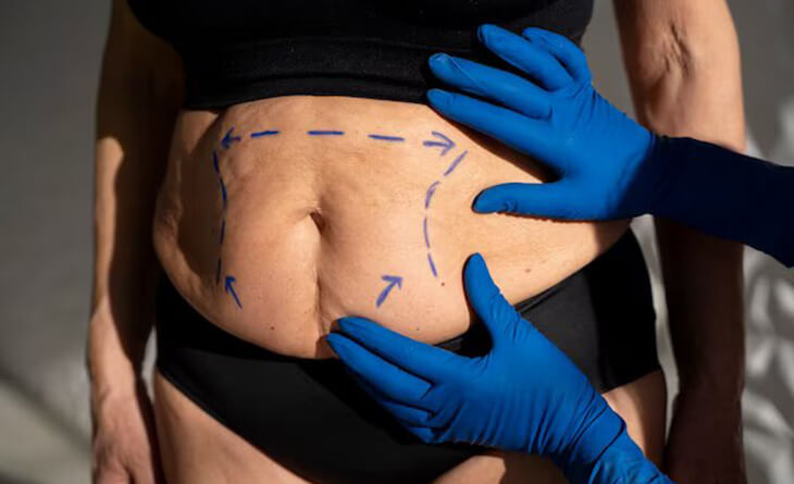 Tummy Tuck Surgery