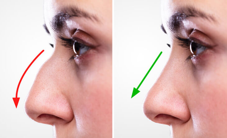 Rhinoplasty Surgery