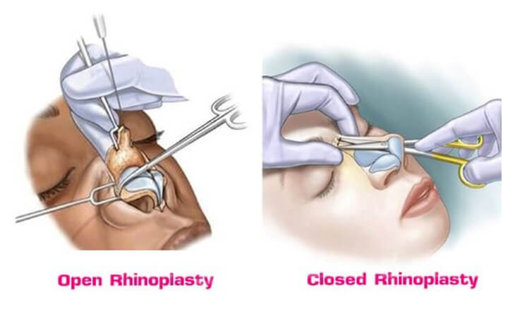 Rhinoplasty Surgery