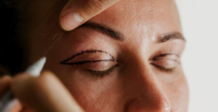 Eyelid Surgery Cost