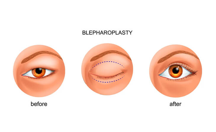 Eyelid Surgery Cost