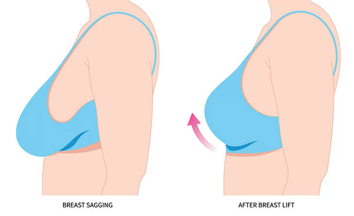 Breast Lift Surgery