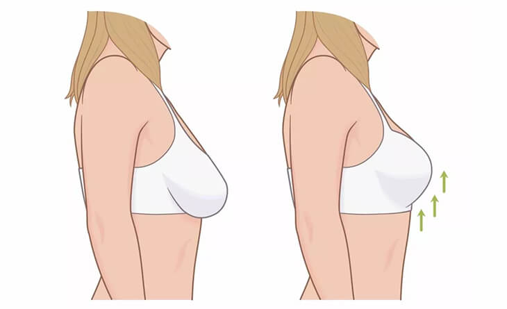 Breast Reduction Surgery