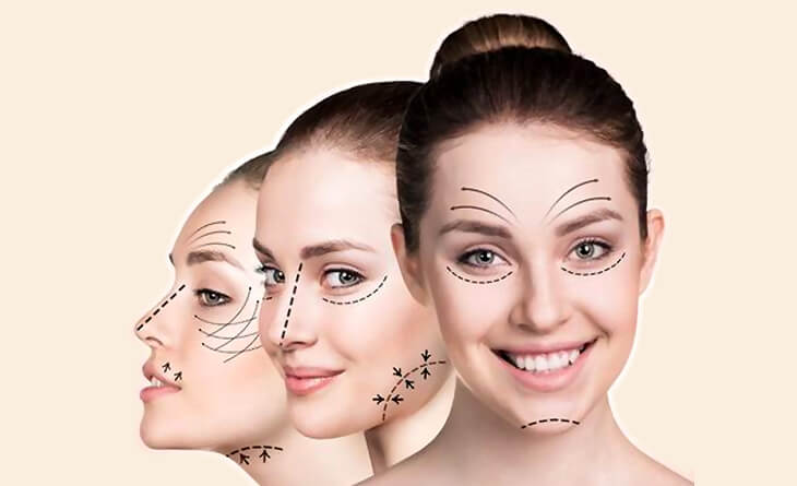 Facelift Surgery