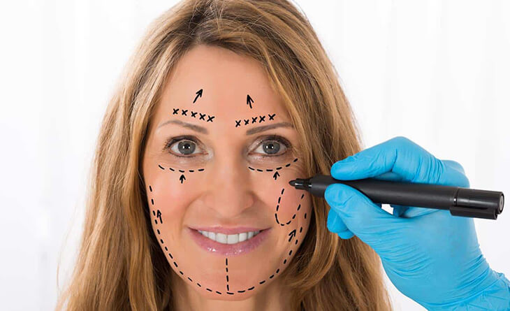 Facelift Surgery