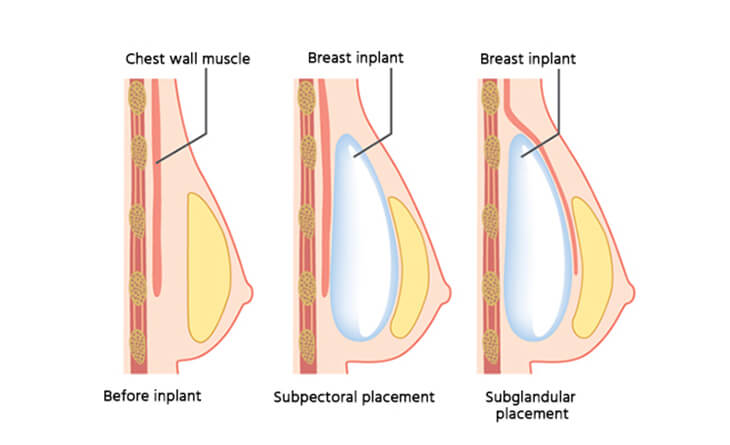 Breast Augmentation Surgery