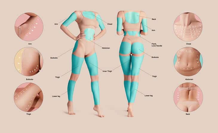 Liposuction Surgery