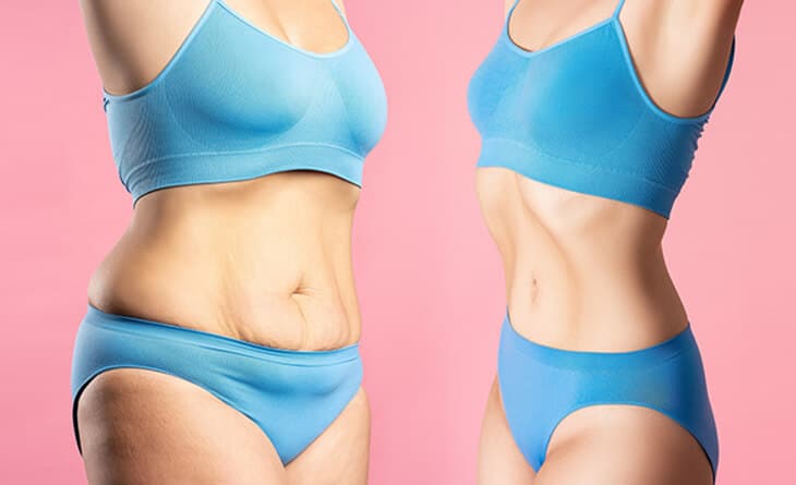 Liposuction Surgery