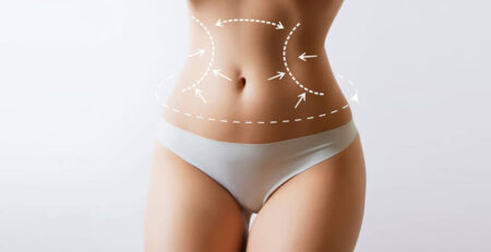 Liposuction surgery