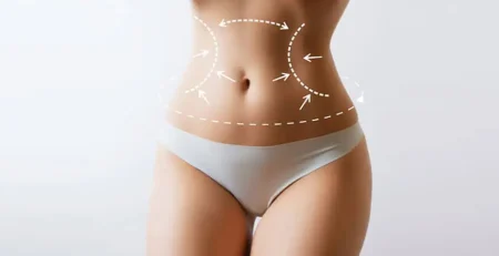 Liposuction surgery