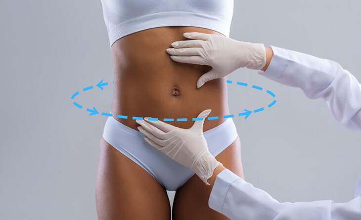 Liposuction surgery