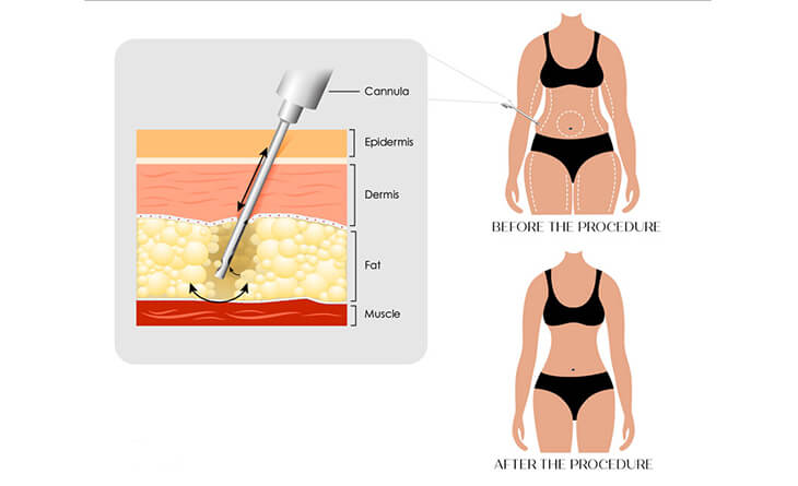 Liposuction surgery