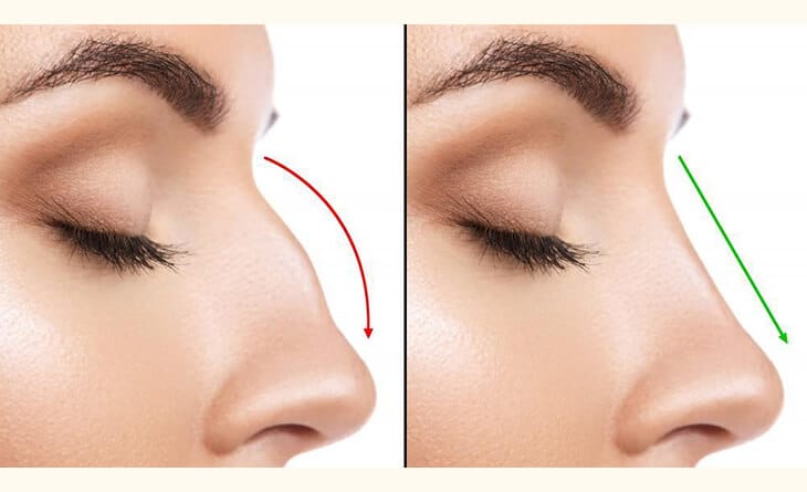 Rhinoplasty Surgery