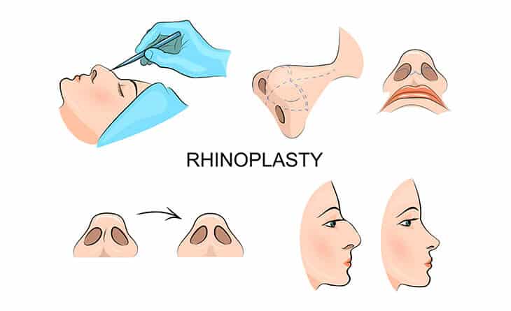 Rhinoplasty Surgery