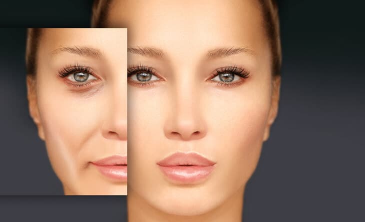 Blepharoplasty Surgery