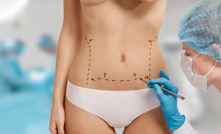 Liposuction Surgery