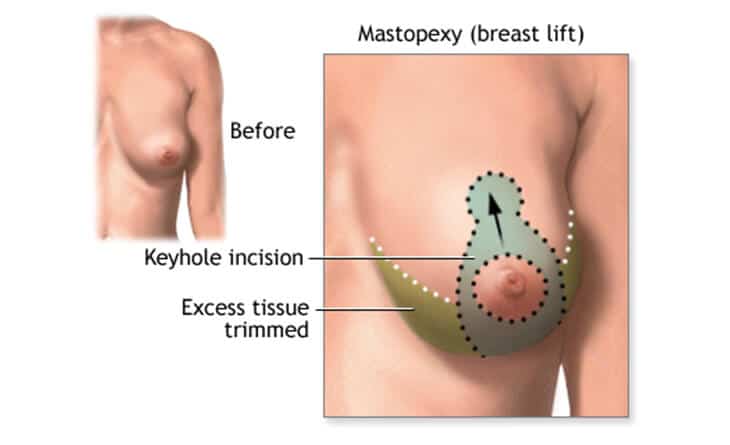 Breast Augmentation Surgery