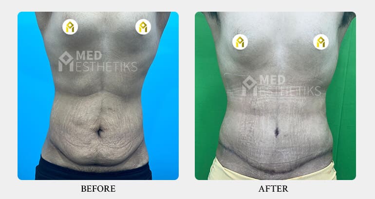 Tummy Tuck Surgery - Dr Lokesh Handa - Med Esthetiks -01