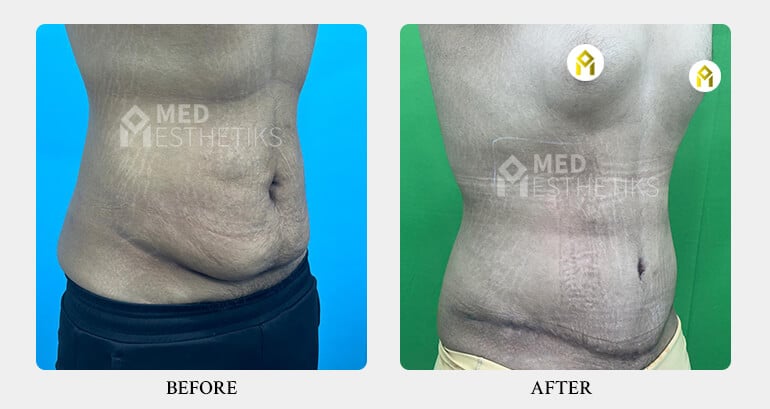 Tummy Tuck Surgery - Dr Lokesh Handa - Med Esthetiks -02