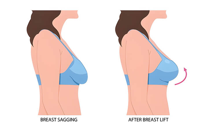 Breast Lift Surgery