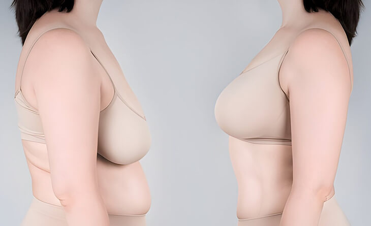 Breast Lift Surgery