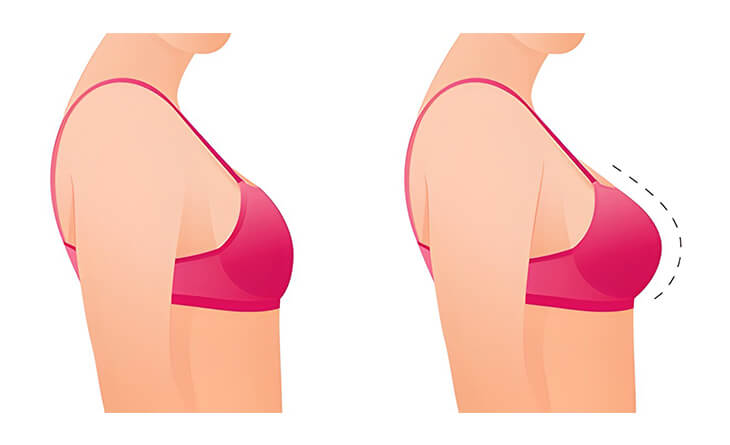 Breast Augmentation Surgery