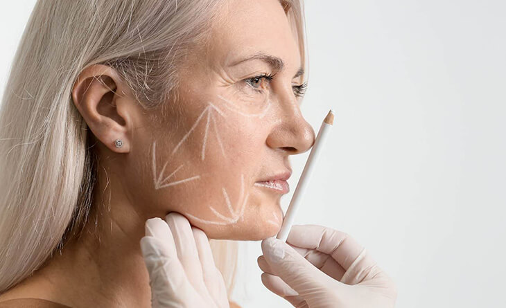 facelift surgery