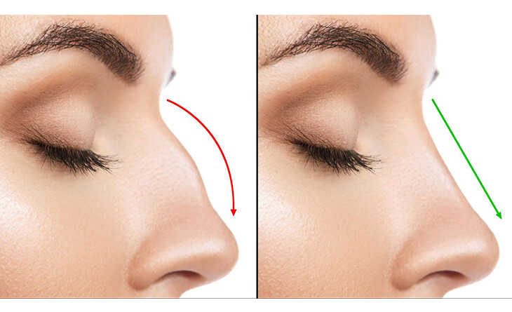 Rhinoplasty Surgery